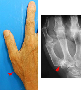 006_thumb-finger-CM-arthropathy