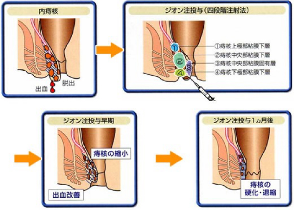 ALTA療法